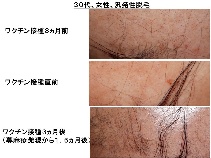 円形脱毛症　病院